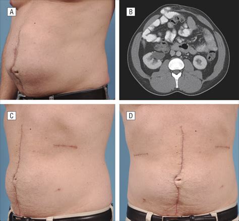 The <b>scar</b> may be higher than a tummy tuck (abdominoplasty) <b>scar</b>, but it often sits under the bikini line. . Abdominal scar revision surgery